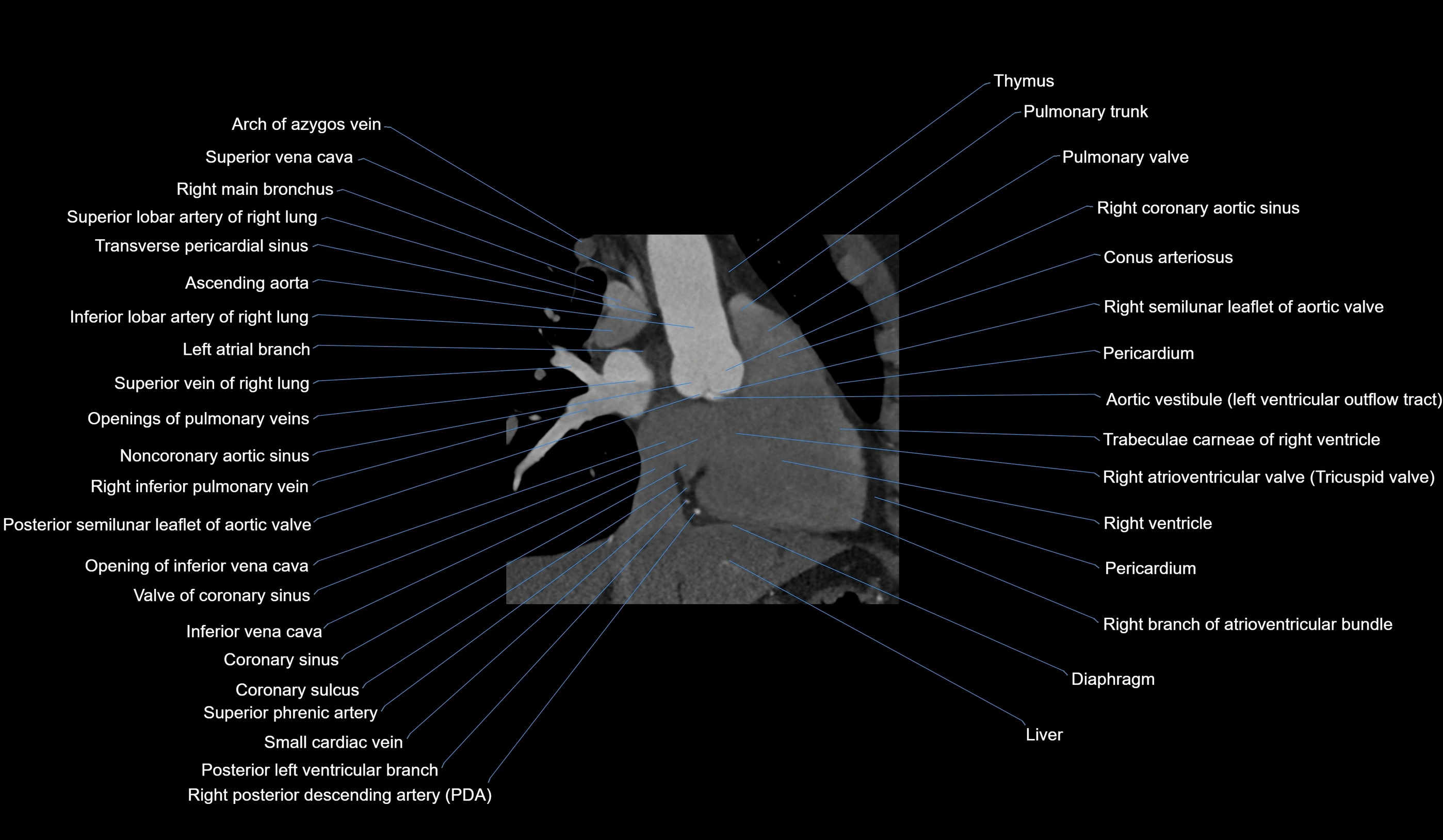 CT heart (coronary angiogram) 2 chamber view cross sectional anatomy labelled radiology image-00025.webp